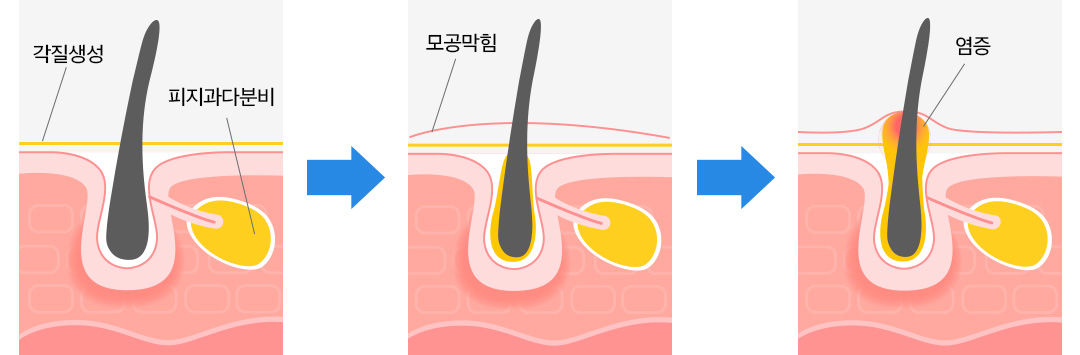 각질생성, 피지과다분비 → 모공막힘 → 염증